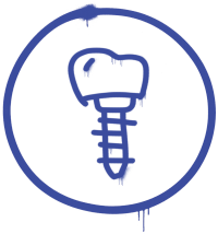 Symbolhafte Darstellung eines Zahnimplantats in blauer Farbe, bestehend aus einer stilisierten Zahnkrone auf einer Schraube. Das Symbol ist von einem Kreis umgeben, wirkt handgezeichnet und weist an mehreren Stellen verlaufene Farbe auf, was ihm einen grafisch-künstlerischen Stil verleiht.