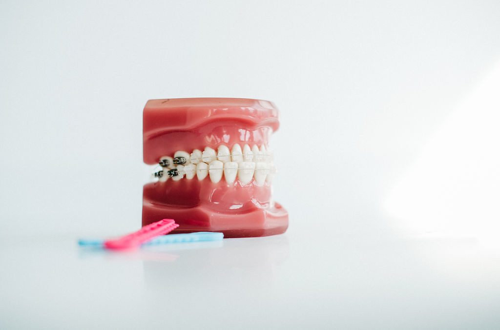 Ein kieferorthopädisches Zahnmodell mit fester Zahnspange steht auf einer weißen Fläche. Die Frontzähne sind mit unauffälligen, ästhetischen Keramikbrackets versehen, während auf den hinteren Zähnen klassische Metallbrackets sichtbar sind. Vor dem Modell liegen zwei bunte Zahnpflegehilfen in Pink und Blau. Die Szene verdeutlicht die Kombination aus Funktionalität und Ästhetik, wie sie bei festen Keramik-Zahnspangen für Erwachsene eingesetzt wird.